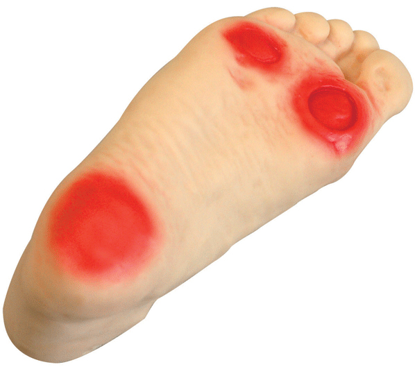 高級糖尿病足護理模型 高級糖尿病足護理模型