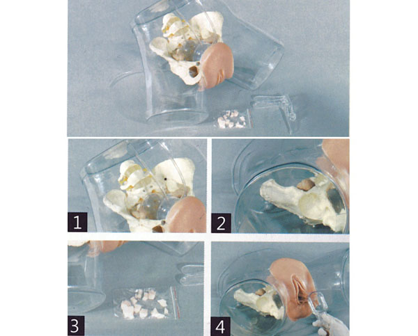 透明刮宮演示模型 透明刮宮演示模型