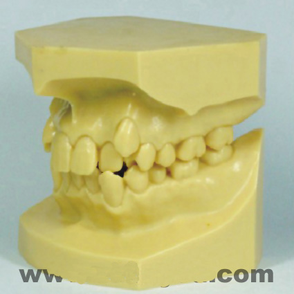 錯(cuò)頜畸形分類演示模型A 錯(cuò)頜畸形分類演示模型A