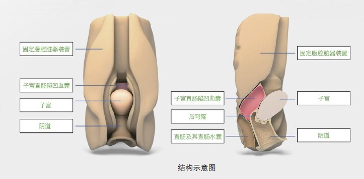 陰道后穹窿穿刺監(jiān)測考核指導(dǎo)模型,模具 陰道后穹窿穿刺監(jiān)測考核指導(dǎo)模型,模具